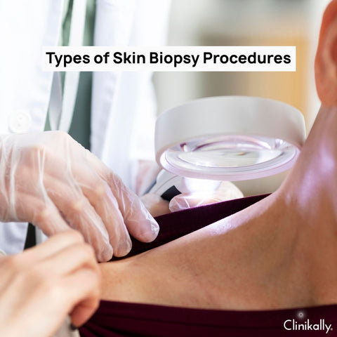 Types of Skin Biopsy Procedures