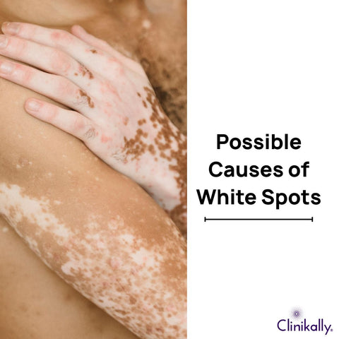 Possible Causes of White Spots