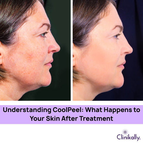 What Happens to Skin After CoolPeelAfter Treatment