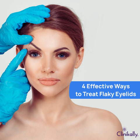 4 Effective Ways to Treat Flaky Eyelids