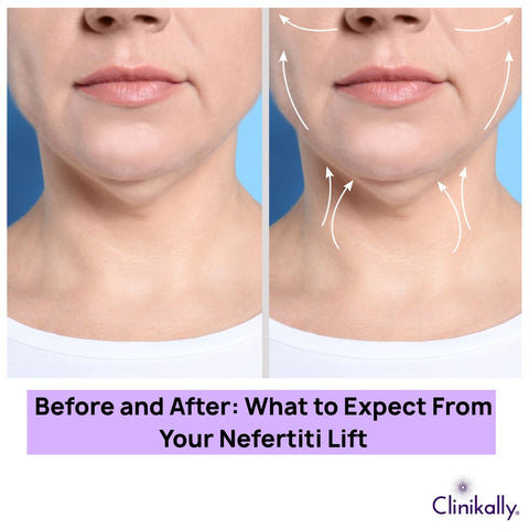 Before and After: What to Expect From Your Nefertiti Lift