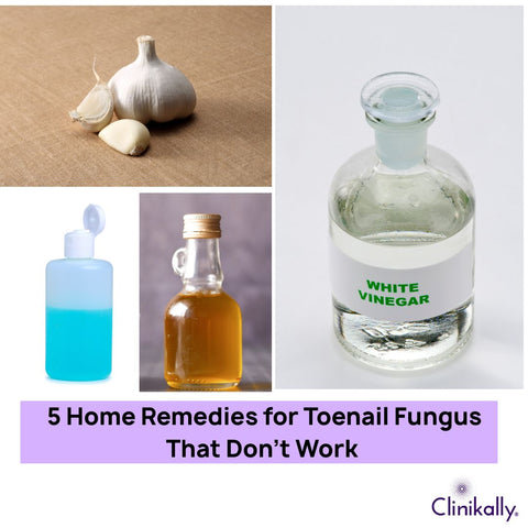 5 Home Remedies for Toenail Fungus That Don’t Work