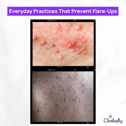 Everyday Practices That Prevent Flare-Ups
