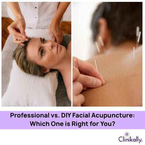 Professional vs. DIY Facial Acupuncture: Which One is Right for You?