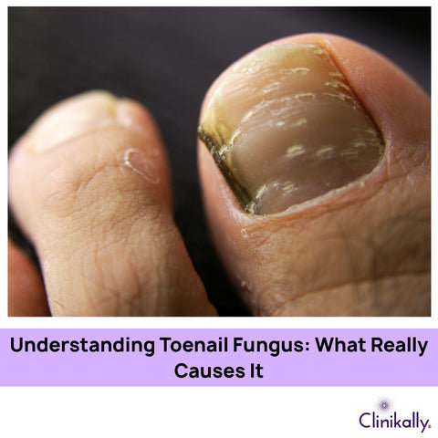 Understanding Toenail Fungus: What Really Causes It