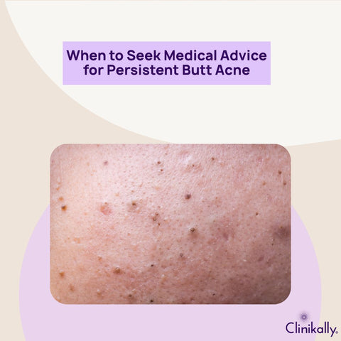 When to Seek Medical Advice for Persistent Butt Acne
