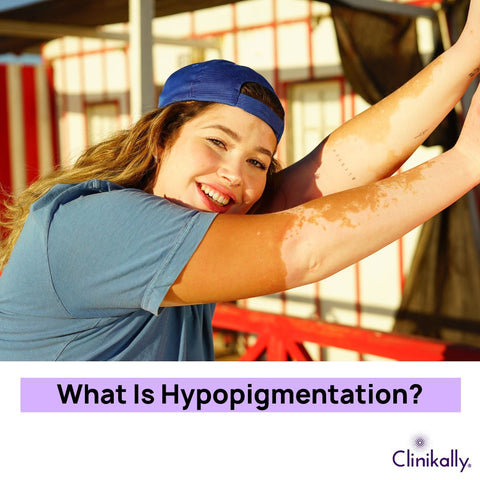 What Is Hypopigmentation?