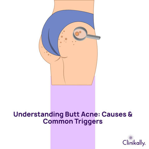 Understanding Butt Acne: Causes & Common Triggers