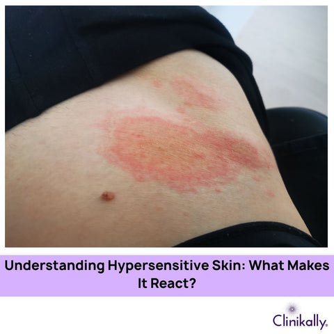 Understanding Hypersensitive Skin: What Makes It React?