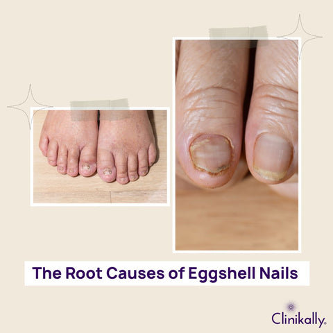 The Root Causes of Eggshell Nails