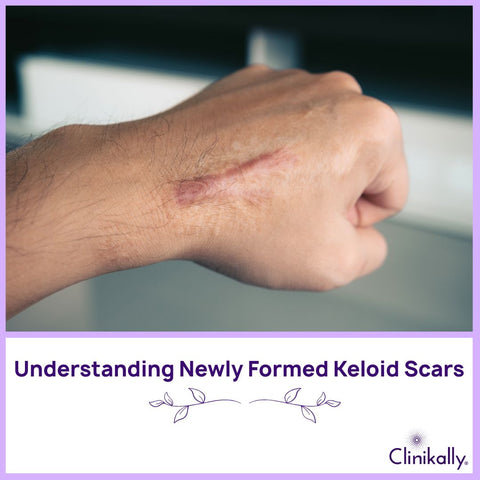 Understanding Newly Formed Keloid Scars