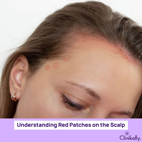 Understanding Red Patches on the Scalp