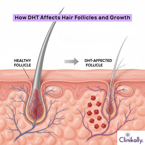 Understanding DHT and Its Role in Hair Loss