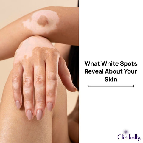 What White Spots Reveal About Your Skin