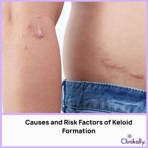 Causes and Risk Factors of Keloid Formation