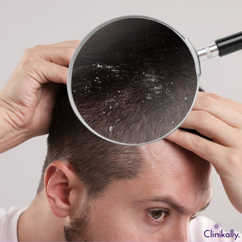 Calm Your Scalp and Stop the Itch