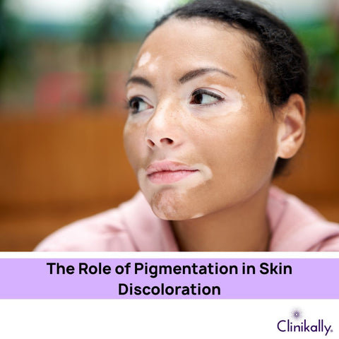 The Role of Pigmentation in Skin Discoloration