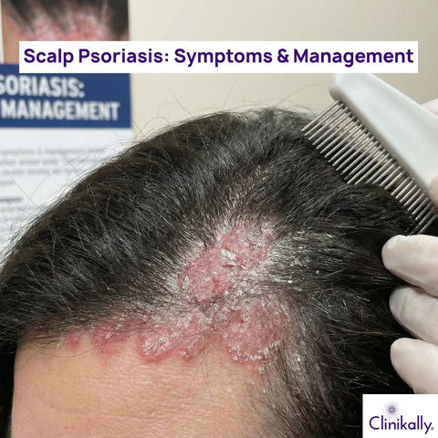 Scalp Psoriasis: Symptoms & Management