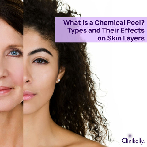 What is a Chemical Peel? Types and Their Effects on Skin Layers