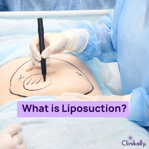 What is Liposuction?