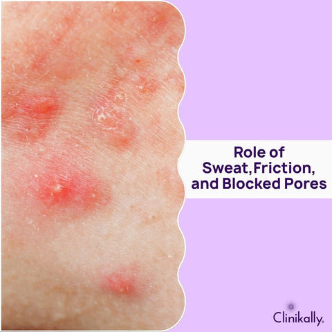 Role of Sweat, Friction, and Blocked Pores