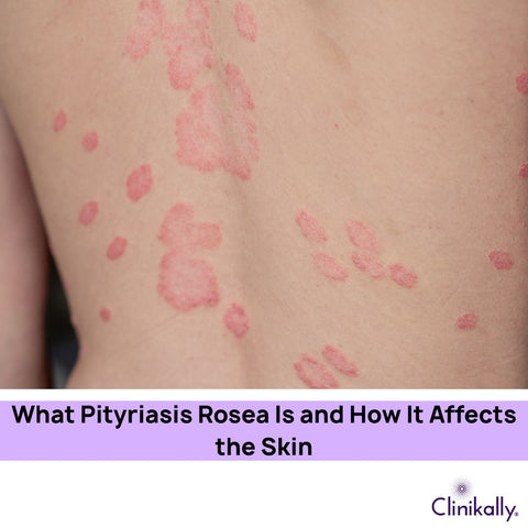 What is Pityriasis Rosea and How Does It Affect the Skin?