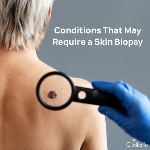 Conditions That May Require a Skin Biopsy