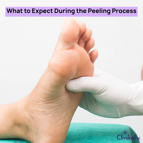 What to Expect During the Peeling Process