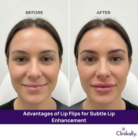 Advantages of Lip Flips for Subtle Lip Enhancement