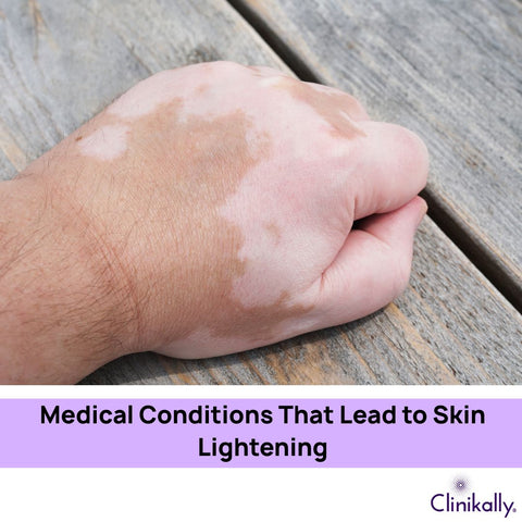 Medical Conditions That Lead to Skin Lightening