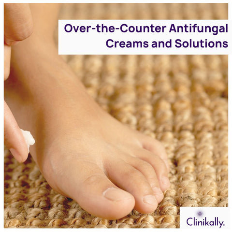 Over-the-Counter Antifungal Creams and Solutions