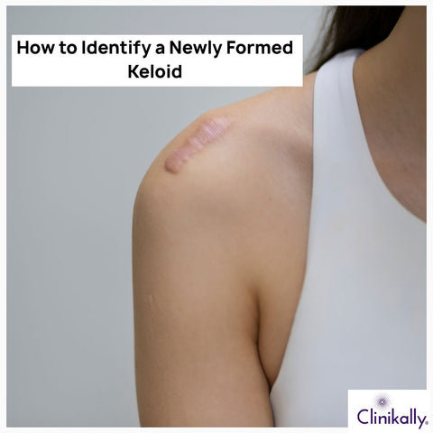 How to Identify a Newly Formed Keloid