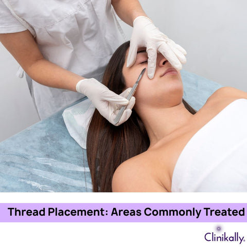 Thread Placement: Areas Commonly Treated