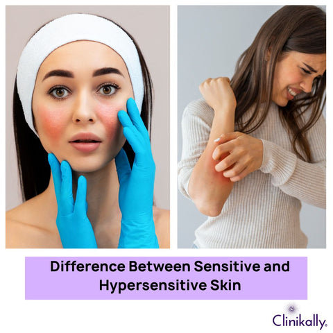 Difference Between Sensitive and Hypersensitive Skin