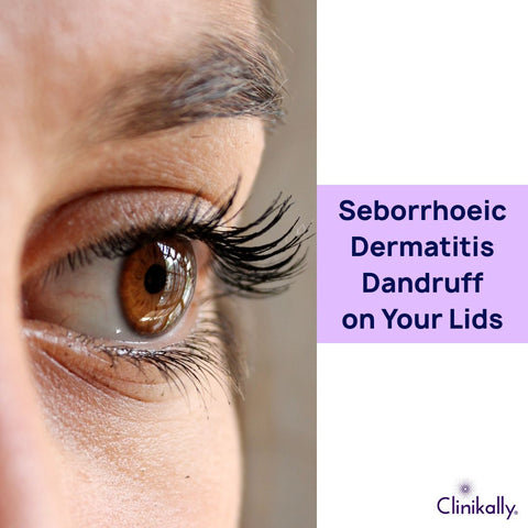 Seborrhoeic Dermatitis: Dandruff on Your Lids