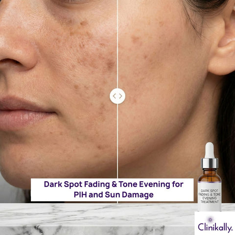 Dark Spot Fading & Tone Evening for PIH and Sun Damage