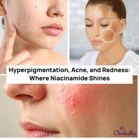 Hyperpigmentation, Acne, and Redness