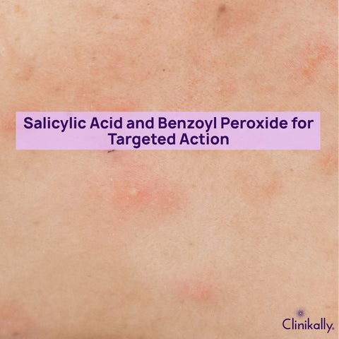 Salicylic Acid and Benzoyl Peroxide for Targeted Action