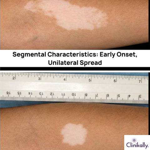 Segmental Characteristics: Early Onset, Unilateral Spread