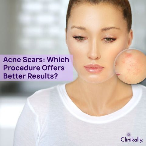 Acne Scars: Which Procedure Offers Better Results?