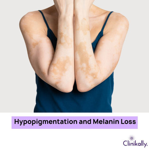 Hypopigmentation and Melanin Loss