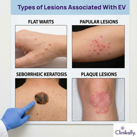 Types of Lesions Associated With EV