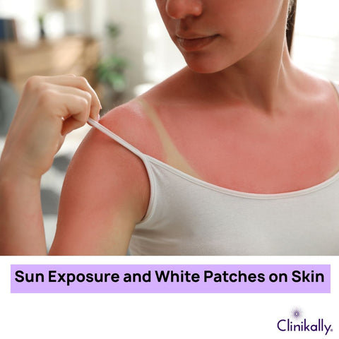 Sun Exposure and White Patches on Skin