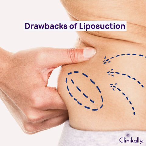 Drawbacks of Liposuction