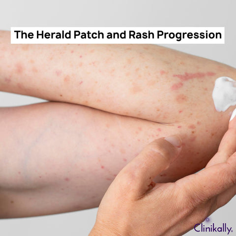The Herald Patch and Rash Progression