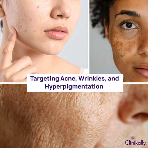 Targeting Acne, Wrinkles, and Hyperpigmentation