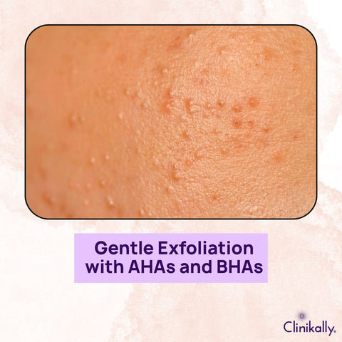 Gentle Exfoliation with AHAs and BHAs