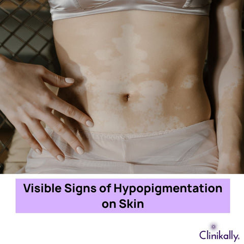 Visible Signs of Hypopigmentation on Skin