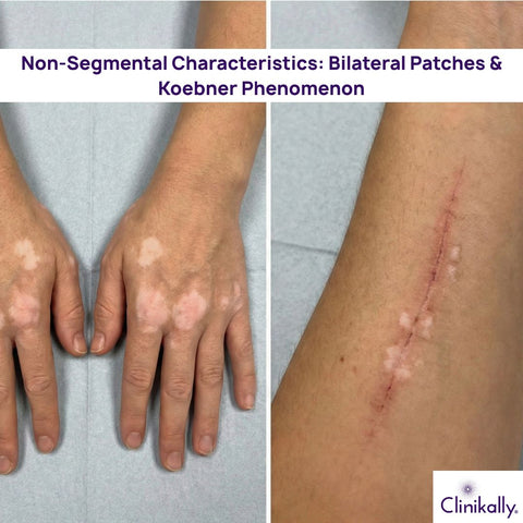 Non‑Segmental Characteristics: Bilateral Patches & Koebner Phenomenon