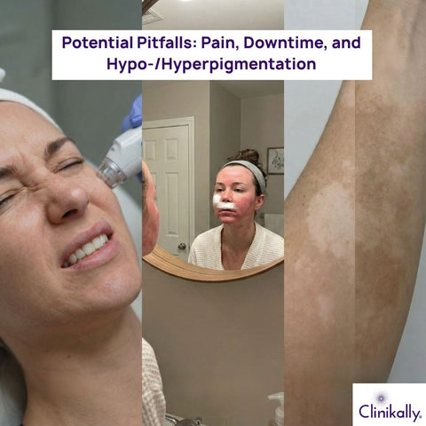 Potential Pitfalls: Pain, Downtime, and Hypo‑/Hyperpigmentation